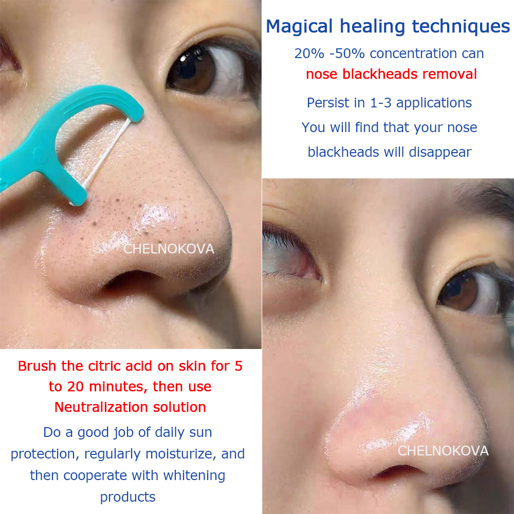 Citric acid 20% 30% 40% 50% pe - مراجعة Skincare Whitening وسعره
